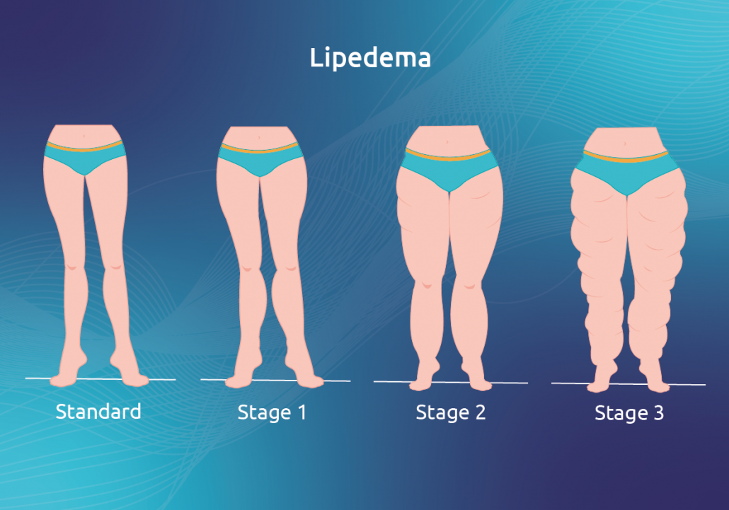 the-differents-stages-of-lipedema