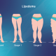 the-differents-stages-of-lipedema