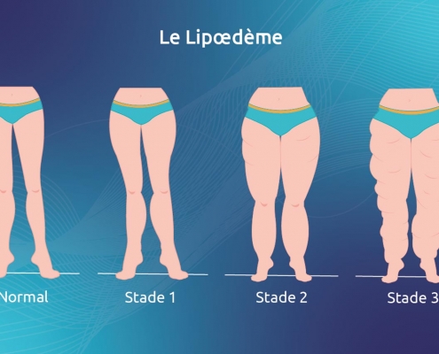 Les différents stades du lipoedème